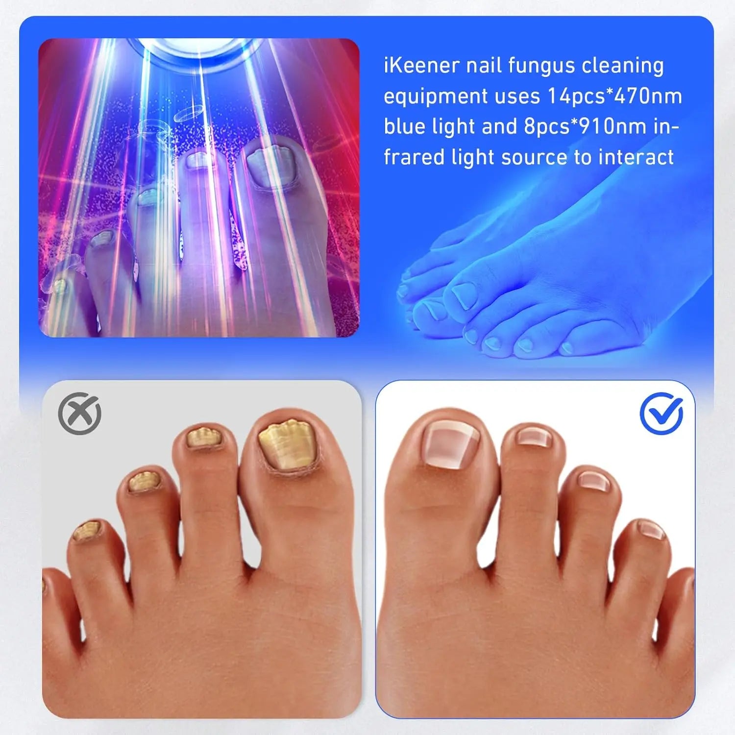 Wireless Nail Fungus Laser Device for Toenails Onychomycosis Infrared Light 470nm 910nm Blue Light Anti Fungal Laser Equipment
