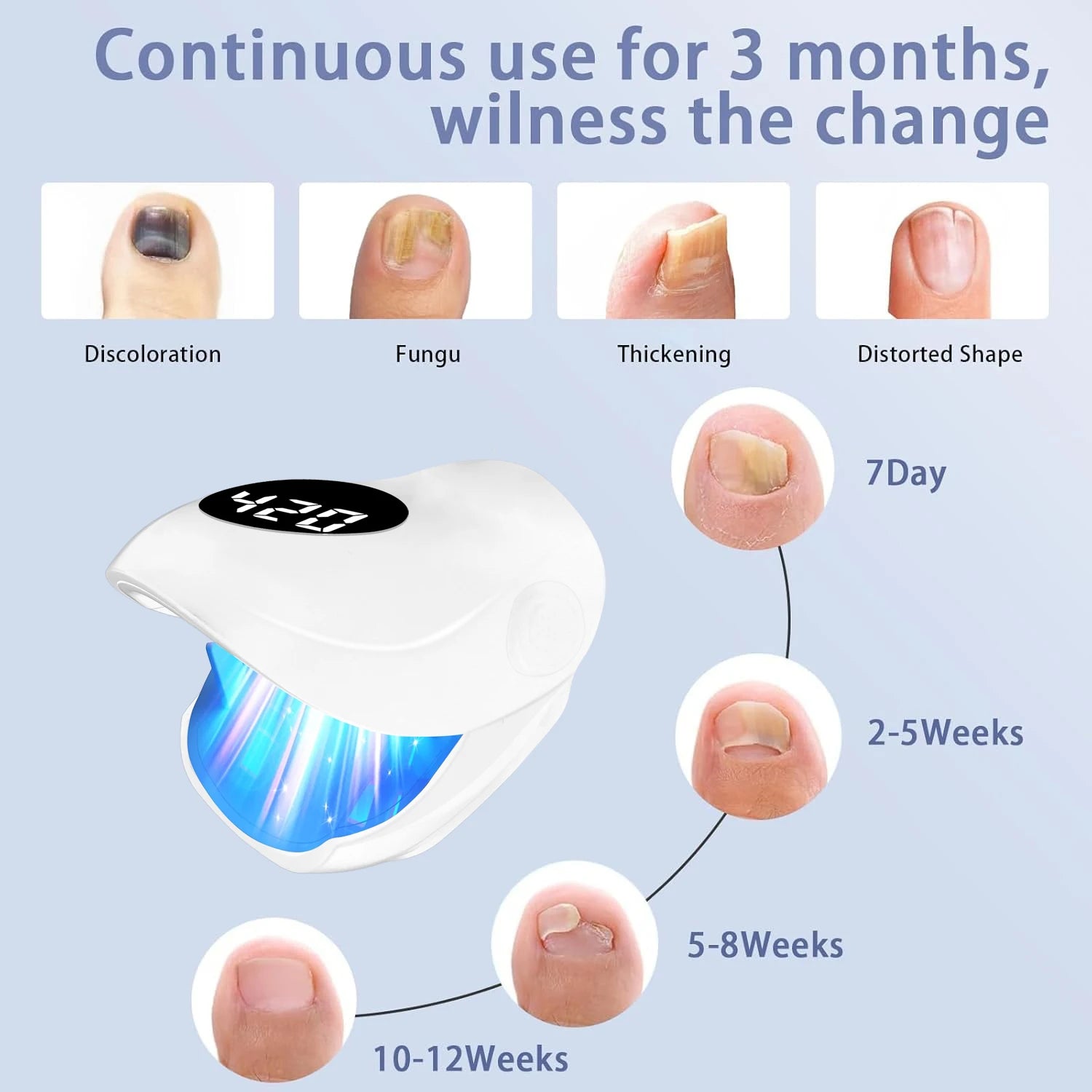 USB Charging Nail Fungus Treatment Device - 940nm Infrared & 500nm Blue Light LED Laser Onychomycosis Nail Care